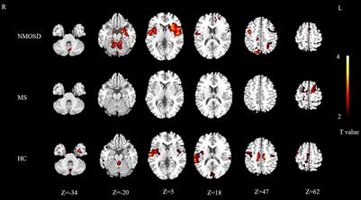 Comparative Study of Brain fMRI of Olfactory Stimulation in Neuromyelitis Optica Spectrum Disease and Multiple Sclerosis